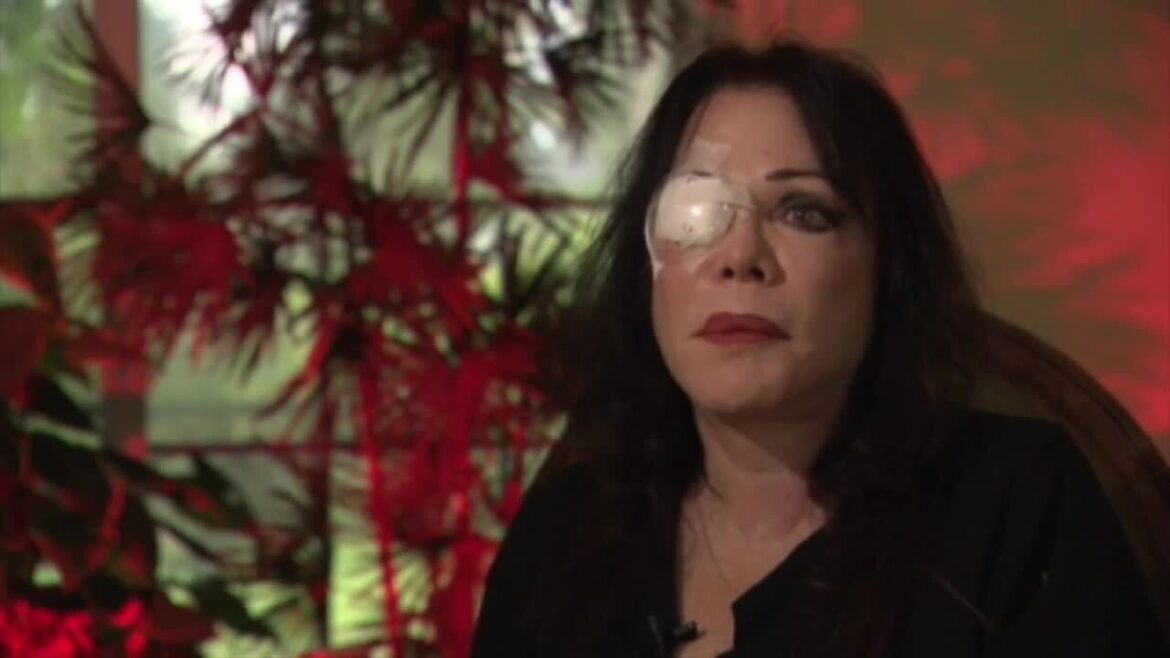 South Florida Woman Says Her Facelift Surgery Left Her Nearly